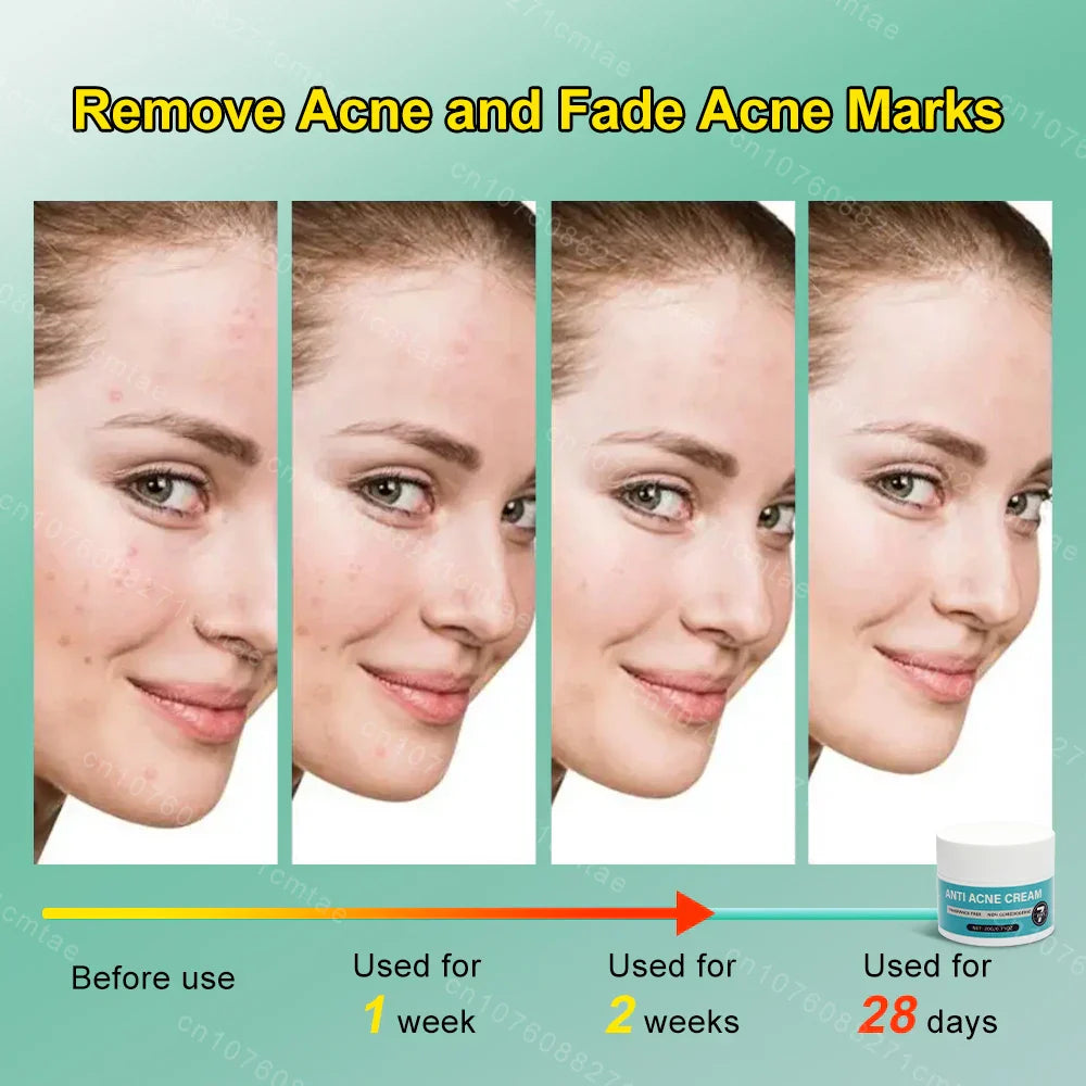 Acne Treatment Repair Acne Marks Deep Cleansing Shrink Pores Moisturizing Skin Care Products